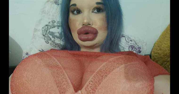 At only 24, she started her 27th lip augmentation