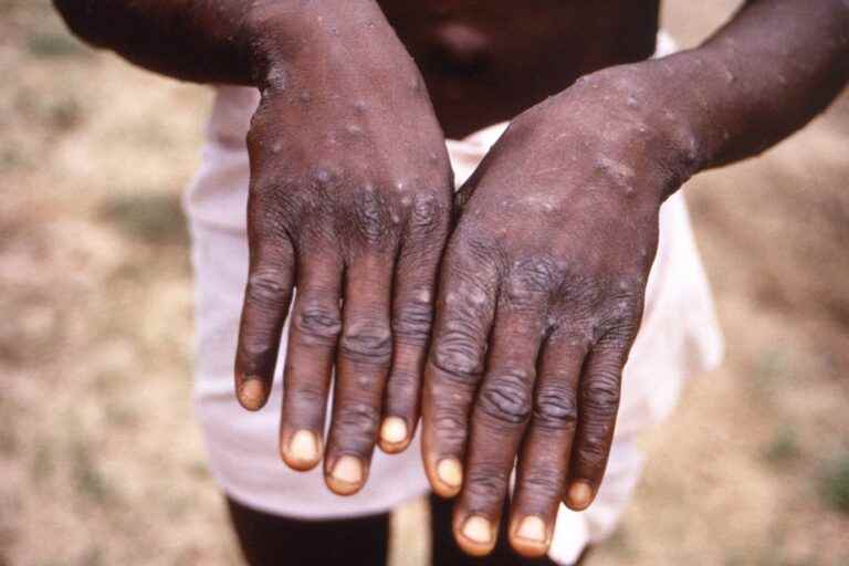 Monkey pox |  Montreal Public Health will provide an update on Thursday