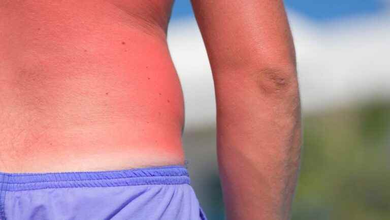 How to treat summer sores?