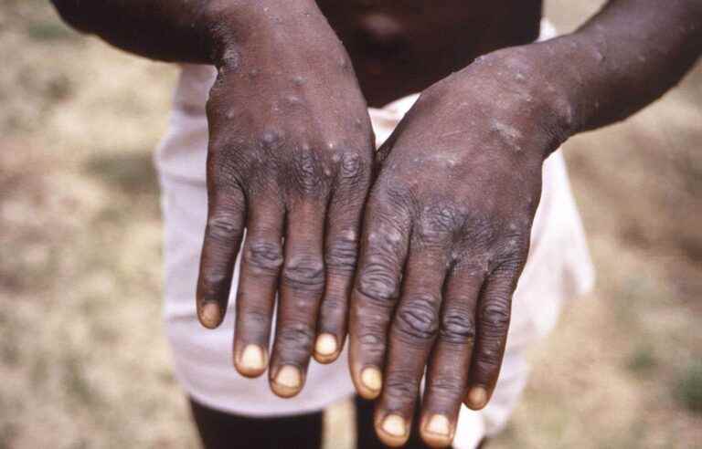 WHO removes distinction between endemic and non-endemic countries for monkeypox