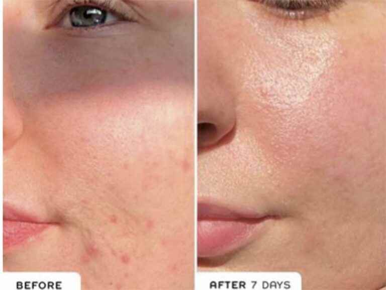 this barrier-protecting elixir reduces redness and blemishes in 7 days