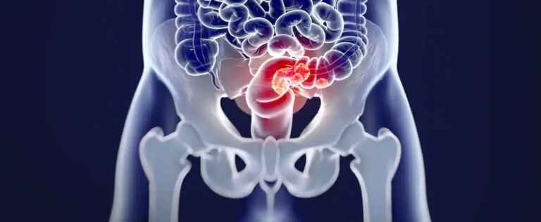 Colorectal cancer must be a priority, argues CCS