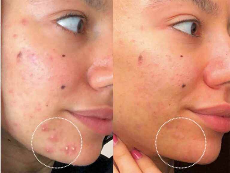 this anti-blemish range eliminates pimples in just 8 days