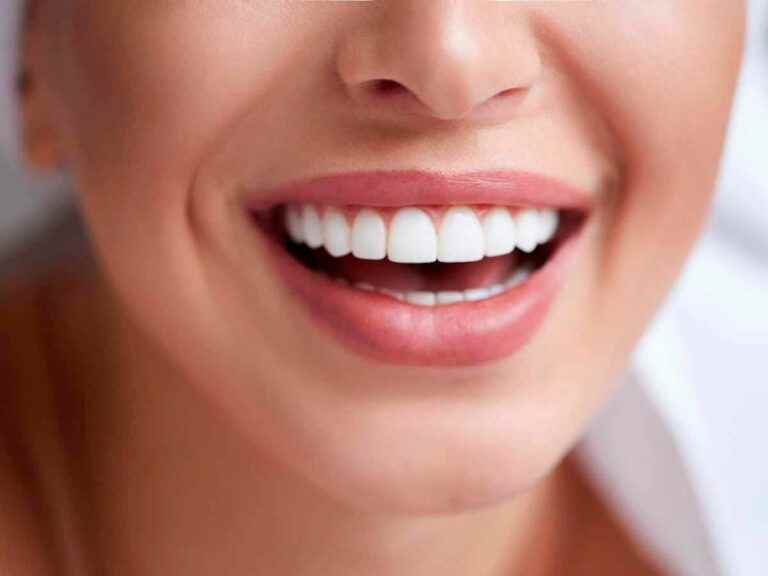 3 things to know about teeth whitening by gutter with Labo du Sourire!