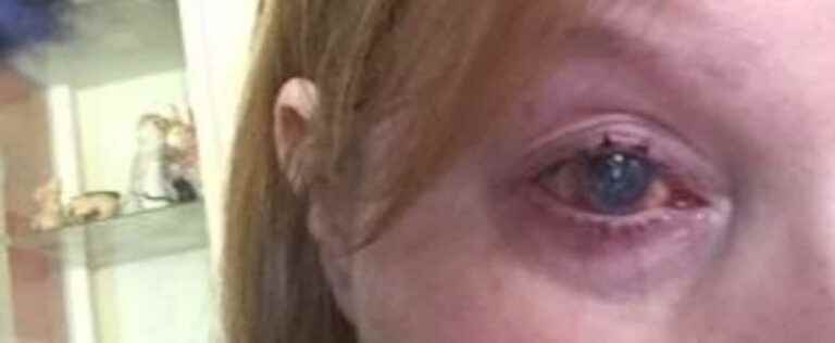 She loses her eye after contracting a parasite while taking a shower