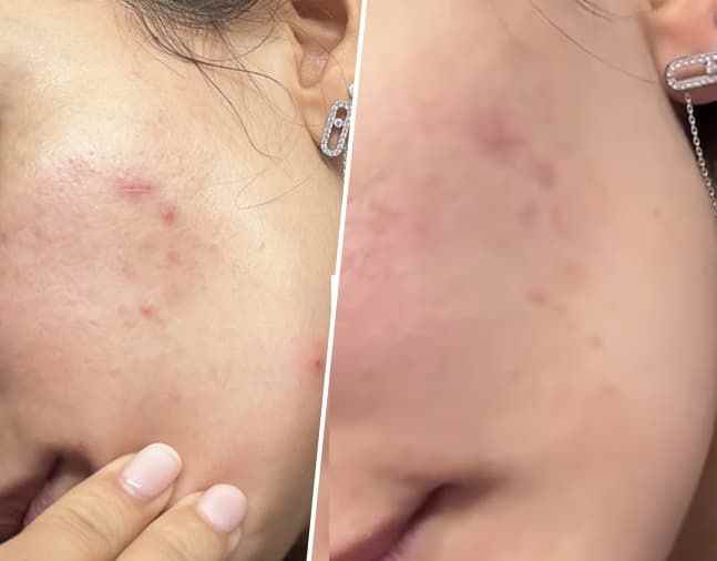 This anti-blemish treatment makes pimples disappear in just one week