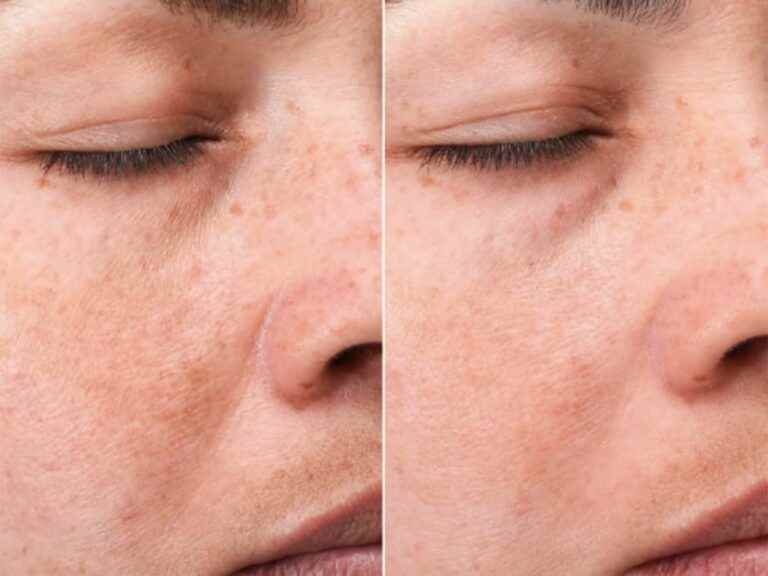 this treatment which reduces the intensity of dark spots and evens out the complexion is creating a buzz