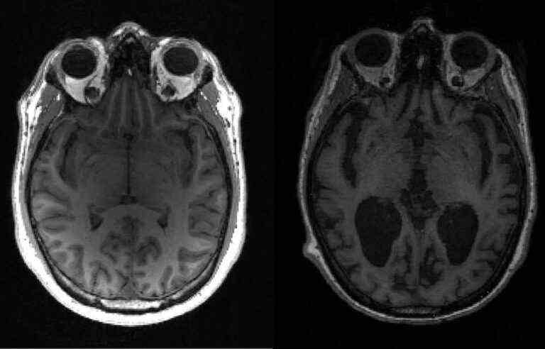 Blood test to detect Alzheimer’s disease authorized in Japan