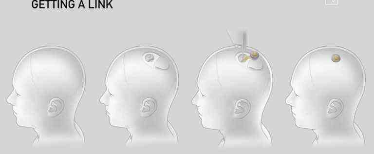 Neuralink promises connected implants in human brains within six months