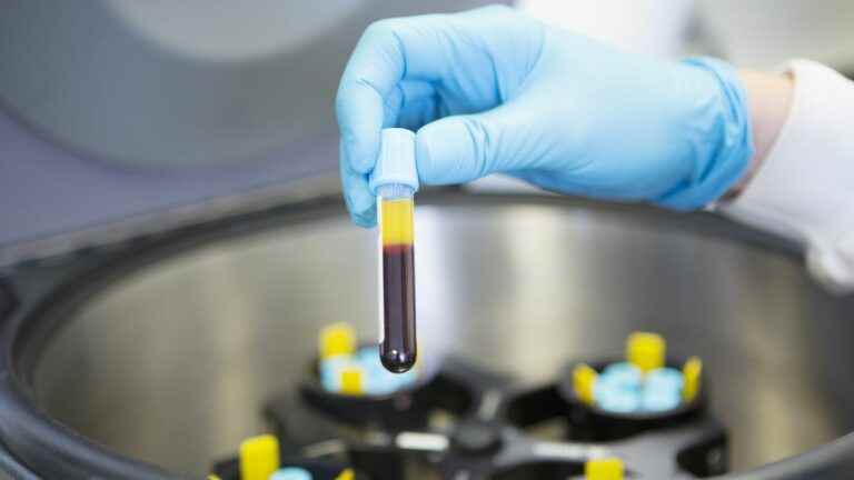 What is Platelet Rich Plasma (PRP)?