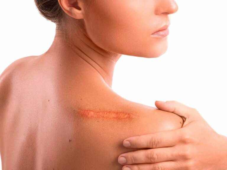 how to reduce scars?