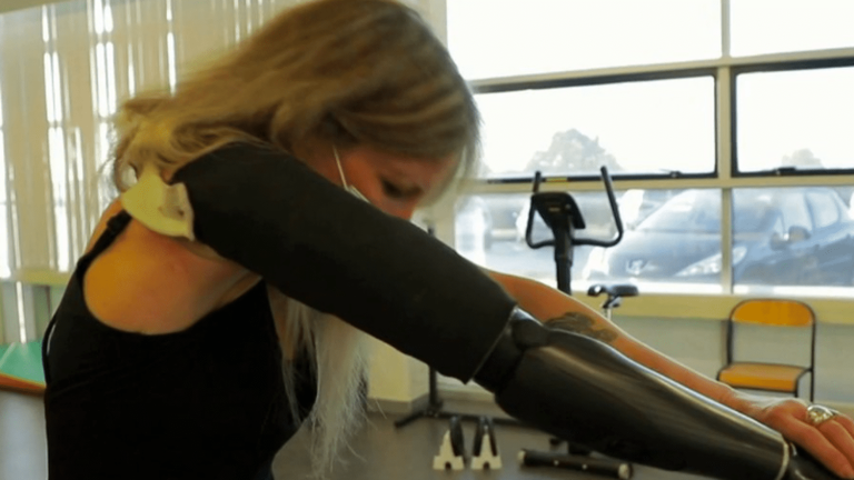 the hope of a bionic arm for an amputated patient 15 years ago