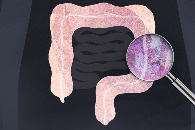 The mystery of early colorectal cancer