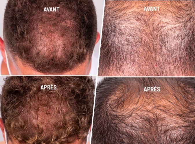 this miraculous serum reduces hair loss by 32% in 45 days (and it’s suitable for pregnant women!)