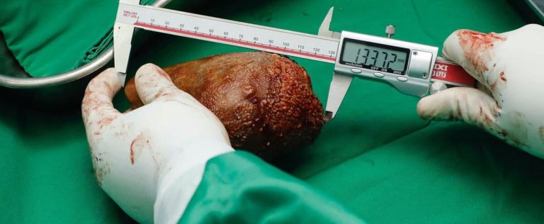 [PHOTOS] World’s largest kidney stone removed from body of Sri Lankan man