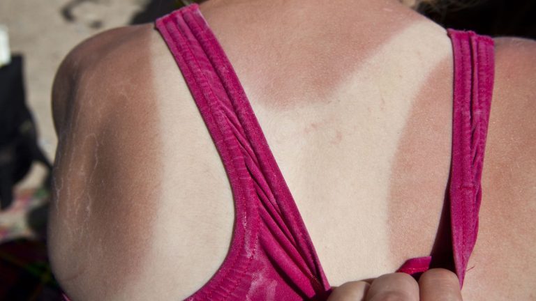 Sunburn away from the beach: beware of photosensitizing treatments