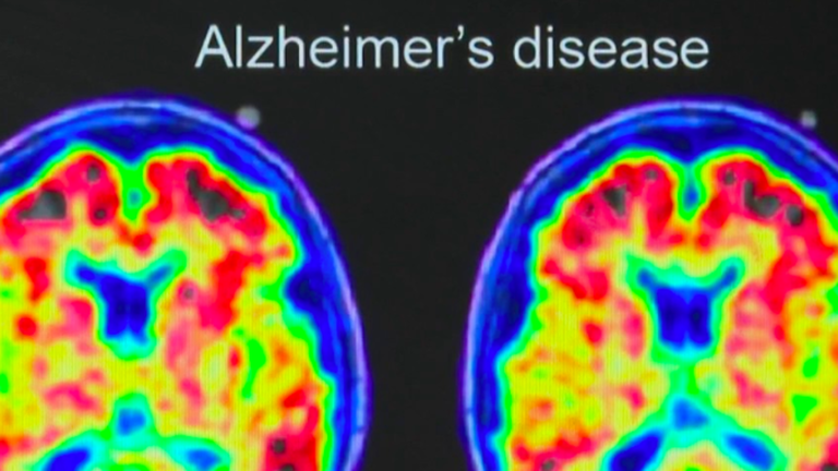 Health: encouraging clinical trials to cure Alzheimer’s disease?