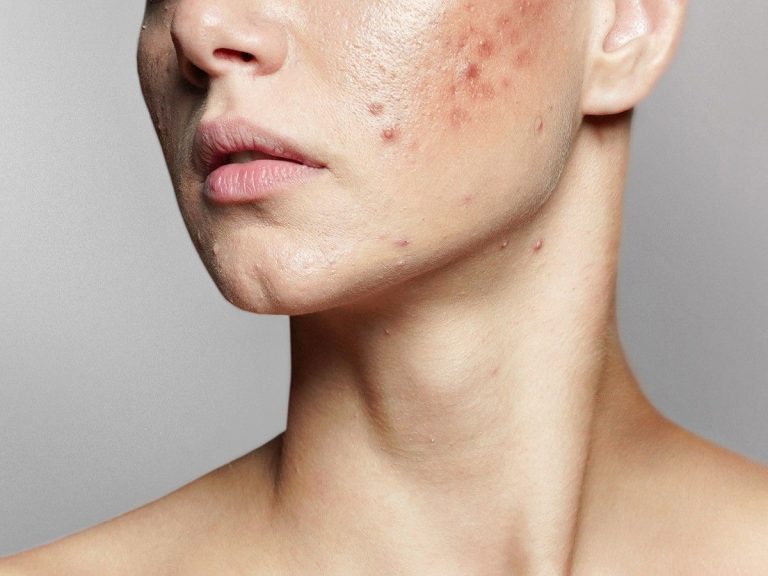 why do we have acne after 25?