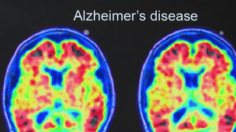 Alzheimer’s: “it’s a very complicated disease”, says comedian Tom Villa