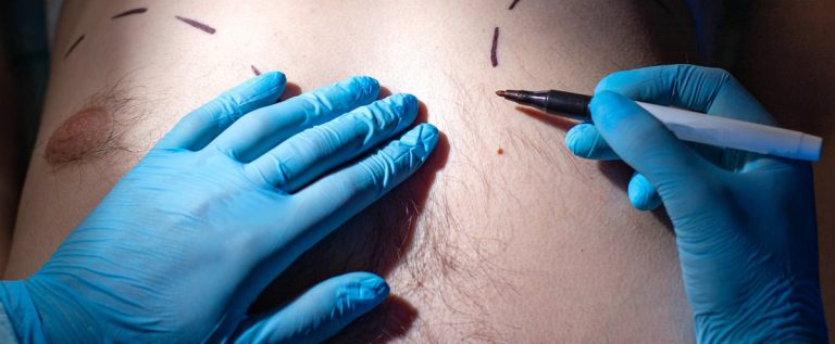 Liposuction, nose, eyelids… discover the 5 most popular plastic surgeries for men