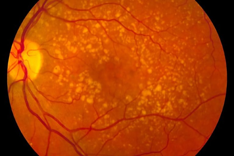 Demystifying science |  Hope for macular degeneration