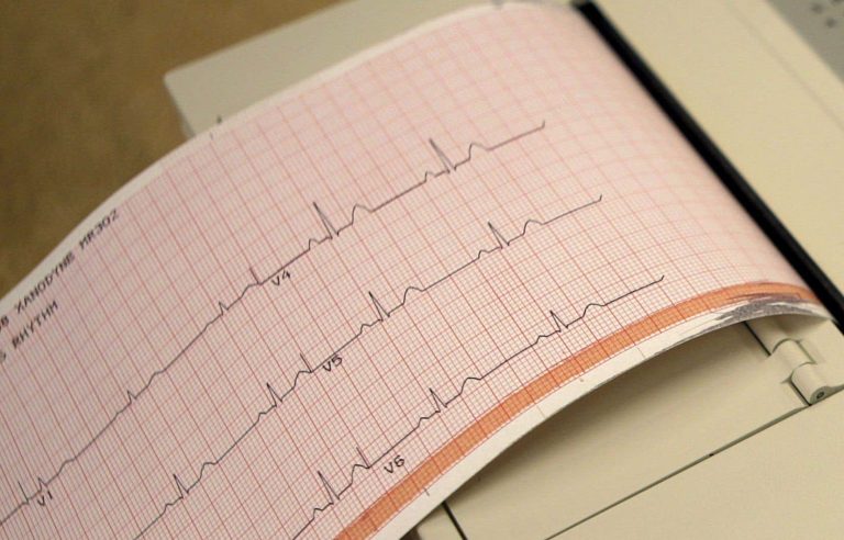 SARS-CoV-2 can infect coronary arteries and cause inflammation