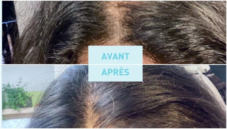 the results of this proven effective anti-hair loss treatment will leave you speechless!