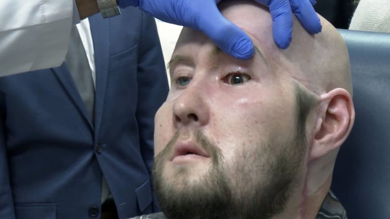 a patient received the first transplant of a complete eye