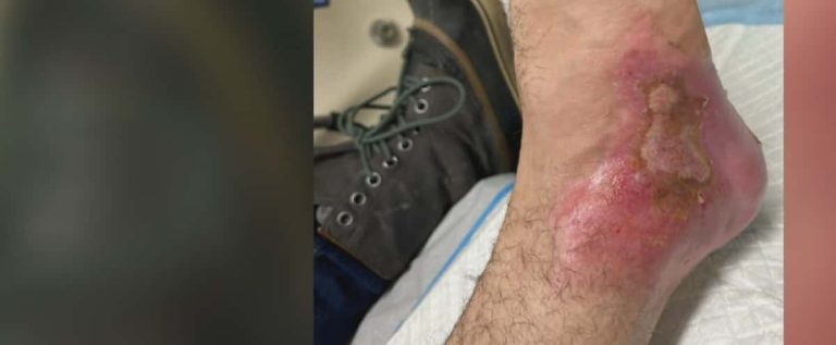 He suffers severe burns after his heated insole catches fire