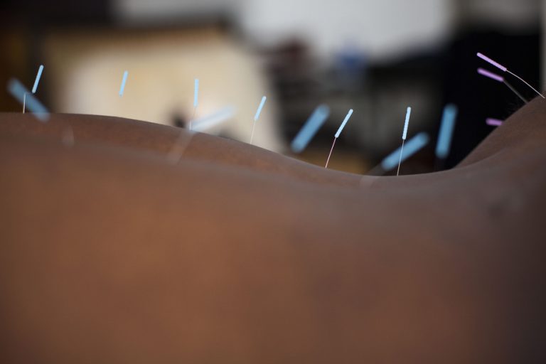 Montreal public health survey |  Fake acupuncturist used needles that may be contaminated