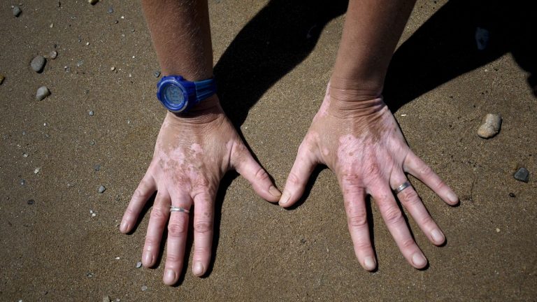 a first authorized treatment for patients with vitiligo available in France