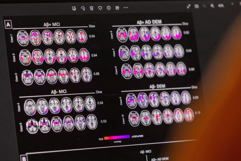 Alzheimer’s |  Authorization for treatment postponed for more analyzes