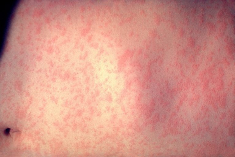 Transmission of measles in Quebec |  “It concerns us,” says the national director of public health