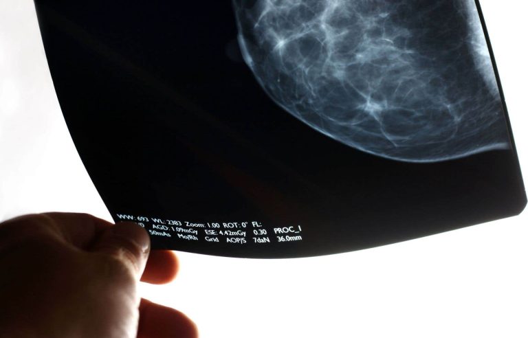 Breast cancer cases are increasing rapidly among young women