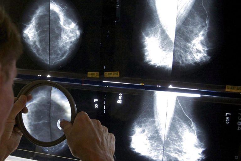 Canada |  Alarming rise in breast cancer cases among young women