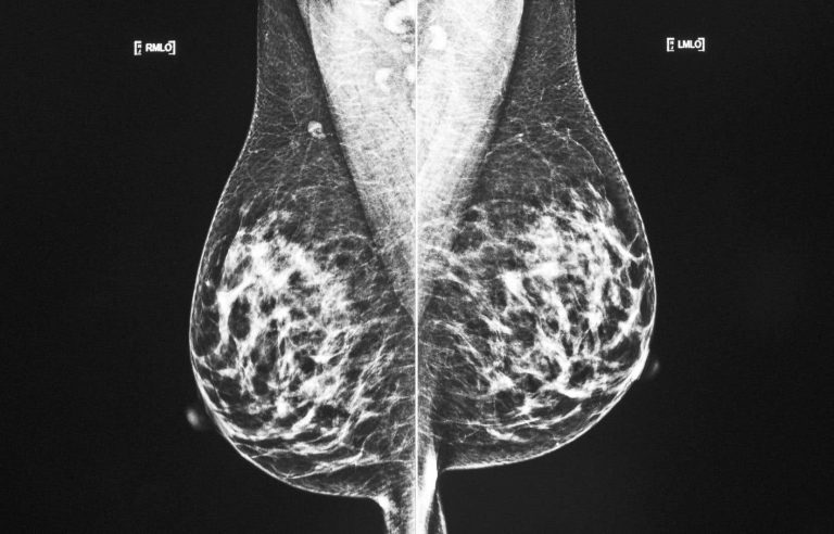 The CHUM now offers cryoablation to treat breast cancer