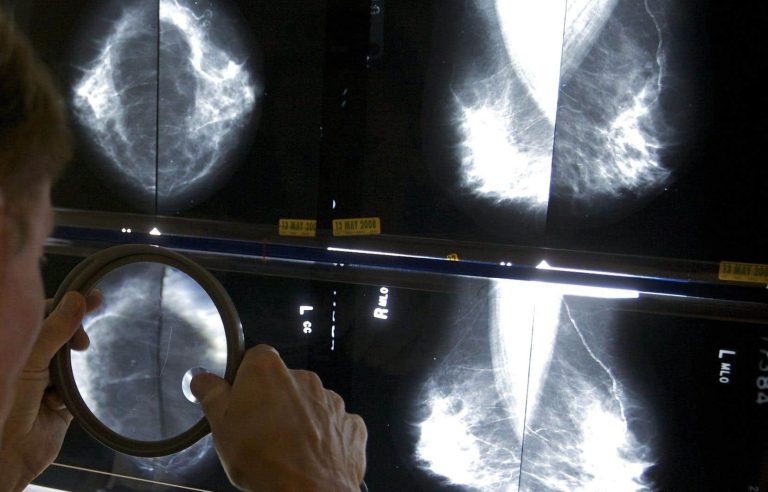 Mammograms recommended from age 40 in the United States