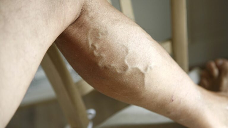 Understanding and treating leg varicose veins