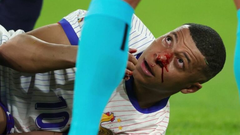 what complications does Kylian Mbappé risk after his broken nose?