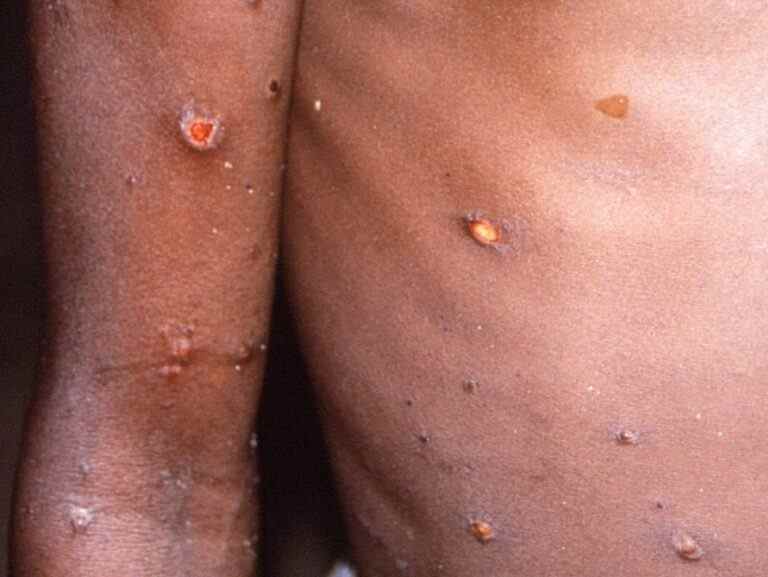 Monkeypox signe de la maladie « nouvelle normalité » ?