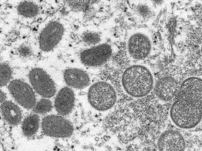 Le nombre de cas confirmés de monkeypox au Québec grimpe à 15