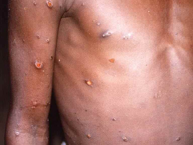 Une épidémie improbable de monkeypox conduira à une pandémie: OMS