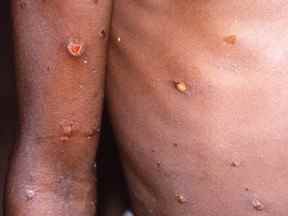 Une image créée lors d'une enquête sur une épidémie de monkeypox, qui a eu lieu en République démocratique du Congo, de 1996 à 1997, montre les bras et le torse d'un patient présentant des lésions cutanées dues au monkeypox, dans cette image non datée obtenue par Reuters le 18 mai 2022.