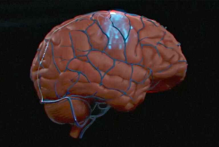 Synchron affirme être le premier à implanter une interface cerveau-ordinateur humain aux États-Unis