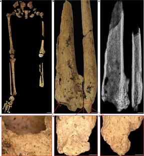 La figure a montre les jambes gauche et droite TB1 avec ceinture pelvienne, démontrant l'absence complète du tiers distal de la jambe gauche.  La figure b montre le tibia gauche et le péroné montrant la surface d'amputation, l'atrophie et la nécrose.  La surface osseuse est plus poreuse car la lyse s'est produite pour éliminer l'os mort (nécrose).  La figure c est une radiographie du tibia et du péroné gauches.  La figure d–f est un os remodelé recouvrant les surfaces d'amputation, démontrant la guérison après l'amputation.  La figure d est la face médiale du tibia gauche.  La figure e est la face médiale du tibia gauche.  La figure f est la face antérieure du péroné gauche.  Images en d–f prises à l'aide d'un microscope numérique Olympus DSX1000.  Barres d'échelle, 5 cm (a), 5 mm (b et c) et 2 mm (d–f).