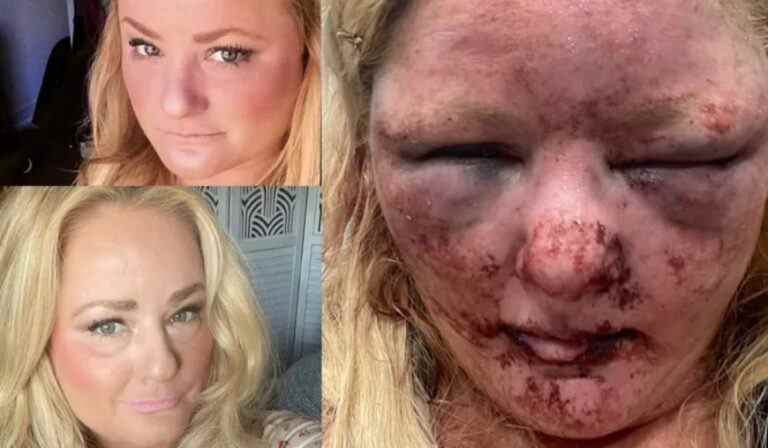 Une victime de viol en Californie partage d’horribles images de blessures au visage