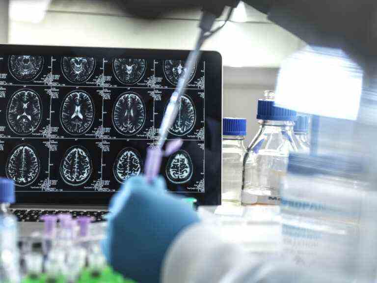 Des chercheurs développent un test sanguin capable de détecter de manière fiable la maladie d’Alzheimer