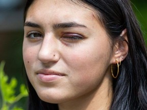 Kali MacDonald, étudiante à l'Université Western, ne peut pas voir de son œil gauche après avoir été frappée par un BB alors qu'elle se tenait avec des amis sur l'avenue Broughdale le 5 septembre. Photo prise le lundi 11 septembre 2023. (Derek Ruttan/London Free Presse)