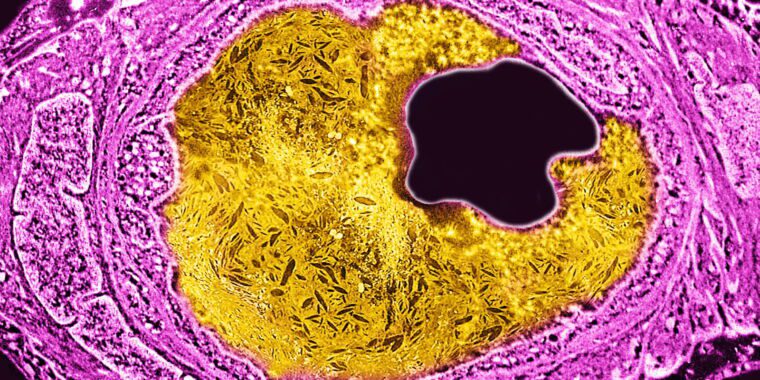 Il a été démontré que l’édition génétique Crispr réduit de manière permanente l’hypercholestérolémie