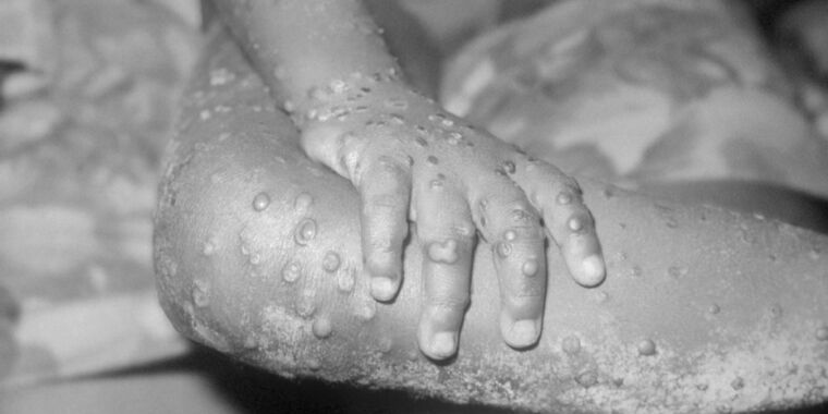 Une nouvelle épidémie de MPOX suscite l’inquiétude ; l’OMS envisage de déclarer une urgence internationale